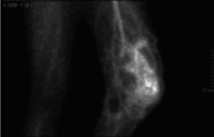Gammagrama óseo: hipercaptación heterogénea y ávida del fármaco en rodilla izquierda.