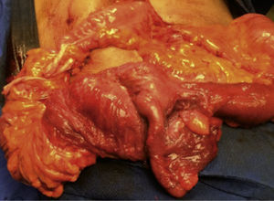 Tumor intususcepto en colon ascendente con apéndice cecal adherido a borde antimesentérico.