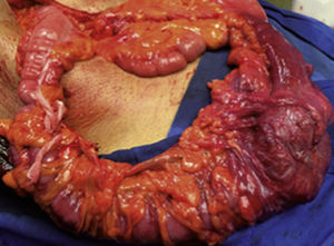 Examen macroscópico de la pieza quirúrgica de 45 cm, de los cuales 32cm corresponden al colon y 13cm al íleon.