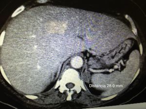 TAC de suprarrenales. Se observa la presencia de masa tumoral de 3.0cm de diámetro en la glándula suprarrenal izquierda.