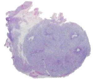 Corte histopatológico de la pieza quirúrgica que demuestra una neoplasia de estirpe epitelial con bordes bien delimitados.