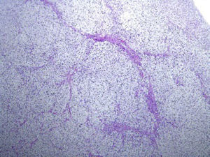 Las células se encuentran dispuestas en grupos o cordones separados por finos tabiques fibrovasculares.