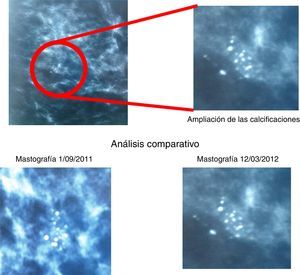 Análisis comparativo de la mastografía del 12 de marzo de 2012.