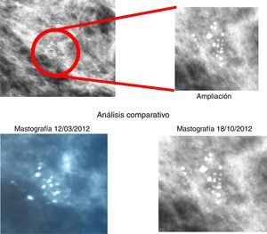 Análisis comparativo de la mastografía del 18 de octubre de 2012.