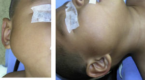 Tumoración en región parotídea derecha en un niño de 5años, sospechosa de lesión de glándula salival.