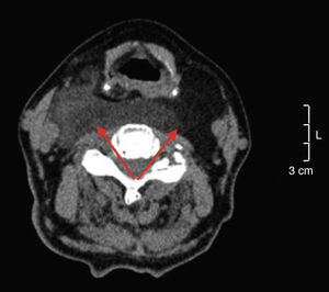 Tomografía computarizada donde se observa la lesión (flechas) en el espacio retrofaríngeo y extensión a ambos espacios parafaríngeos. Se observan los 2 componentes del tumor: el fibroso y el de tejido graso.
