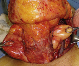 Se puede observar la lesión, con extensión bilateral a espacios parafaríngeos, localizada por detrás de la faringe.