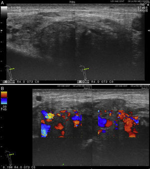 Imágenes de ultrasonografía A) Ultrasonografía simple. Se aprecia en región anterior media del músculo bíceps braquial izquierdo tumoración nodular, heterogénea, de bordes irregulares y mal definidos con invasión a tejidos circundantes, B) Ultrasonografía Doppler de color que muestra un patrón altamente vascularizado.