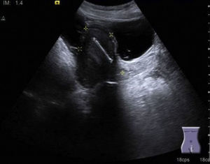 Corte sagital en el que se observa útero con miometrio difusamente heterogéneo y el endometrio central con presencia de dispositivo intrauterino.