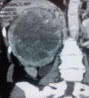TC de abdomen y pelvis: se observa tumor de 223×190mm dependiente del riñón derecho, encapsulado, con tenue trabeculado captador de contraste y amplia necrosis central (20UH).
