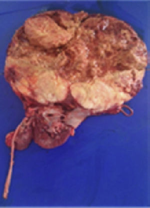 Fotografía de la pieza quirúrgica: se observa tumor de 23.0×18.0cm de color pardo claro, con áreas de hemorragia y necrosis y que destruye los cálices renales e infiltra la cápsula renal, la grasa perirrenal y el seno renal.