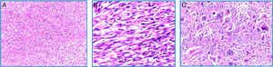 Microscopía (H-E): A. 10×. Vista panorámica del tumor renal en el que se observa proliferación neoplásica fusocelular con patrón de crecimiento estoriforme. B. 40×. Microfotografía a mayor aumento, en la que se observan células fusiformes malignas en relación con sarcoma. Nótese la hipercromasia nuclear. C. 100×. Detalle a alto poder, células pleomórficas gigantes con multinucleación.