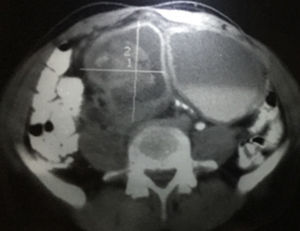 Tomografía con doble contraste, donde se observa lesión tumoral en hueco pélvico.