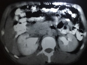 Tomografía contrastada de abdomen.