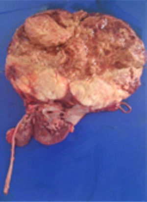 Fotografía de la pieza quirúrgica: se observa tumor de 23.0x18.0cm, de color pardo claro, con áreas de hemorragia y necrosis, que destruye los cálices renales e infiltra la cápsula renal, la grasa perirrenal y el seno renal.