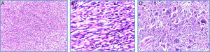 Microscopia (H-E): A. 10×. Vista panorámica del tumor renal en el que se observa proliferación neoplásica fusocelular con patrón de crecimiento estoriforme. B. 40×. Microfotografía a mayor aumento, en la que se observan células fusiformes malignas en relación con sarcoma. Nótese la hipercromasia nuclear. C. 100×. Detalle a alto poder, células pleomórficas gigantes con multinucleación.