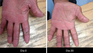 Paciente 3. Afección de manos con fisuras. Tratamiento con emoliente, queratolíticos suaves y reparadores epiteliales.