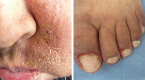 Paciente 4. Complicación de impetiginización sobre piel xerótica en cara y paroniquia.