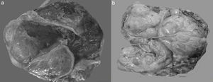 Fotos comparativas de una neoplasia mucinosa primaria de ovario (a) y un adenocarcinoma mucinoso metastásico a ovario (b). A simple vista no es posible distinguir entre una neoplasia primaria y una metastásica, ya que ambas son de gran tamaño, multiloculares y con presencia de abundante mucina.