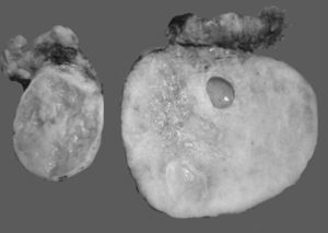 Foto macroscópica de un tumor de Krukenberg. La neoplasia afecta ambos ovarios, es blanca, de aspecto fibroso con pequeñas áreas quísticas. Si la neoplasia fuera unilateral, el principal diagnóstico diferencial sería un fibroma ovárico.