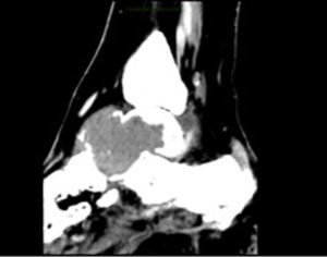 Tomografía axial computarizada, corte sagital en donde se observa lesión lítica en astrágalo con destrucción de las corticales, y extensión a partes blandas y huesos del tarso.