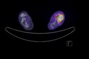 SPECT-CT, corte axial en donde se observa actividad tumoral en hueso astrágalo izquierdo con extensión a hueso calcáneo.