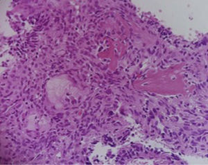 Rodeando al hueso residual (flecha) se observan osteoblastos reactivos, por la presencia de estructuras glandulares diversas, algunas con células con material mucoide en su interior (×40).