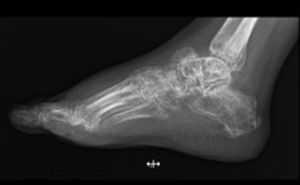 Radiografía lateral del pie izquierdo, en donde se observa integración del astrágalo y huesos del tarso.