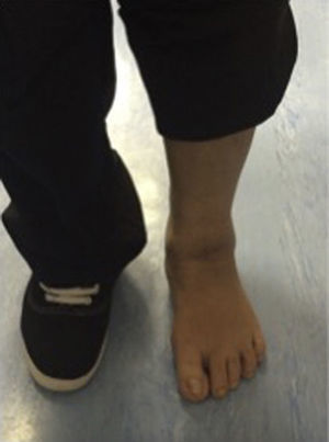 Vista anterior-posterior de la paciente, 12 meses después del inicio de los síntomas tolerando la deambulación.