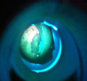 La iluminación de una lesión mucosa con luz fluorescente permite identificar si alrededor de la misma existen cambios preneoplásicos o neoplásicos no perceptibles con luz blanca.