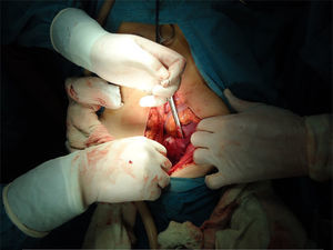 La paciente fue sometida a laparotomía exploradora, salpingooforectomía izquierda y estudio transoperatorio (ETO).