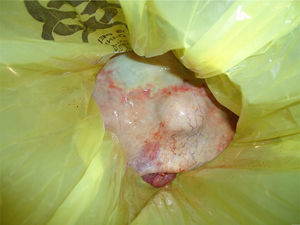 Lesión quística de ovario izquierdo de superficie lisa, color nacarado, con un volumen aproximado de 9 l.