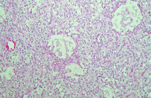 Neoplasia con aspecto quístico tapizada por varias capas de células que presentan núcleo redondo con atipia leve y citoplasma finamente vacuolado.