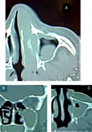 A) TAC inicial previa a la biopsia, con masa tumoral que ocupa la fosa nasal izquierda, sin sobrepasar la línea media y con extensión al seno maxilar izquierdo. B) TAC posterior a la biopsia escisional de la fosa nasal con turbinectomía; fosa nasal izquierda libre, cornete izquierdo ausente, tumoración con afectación de la pared nasal externa. C) Tumoración que ocupa el seno maxilar, sin extensión a la órbita (figs. B y C son previas a la maxilectomía).