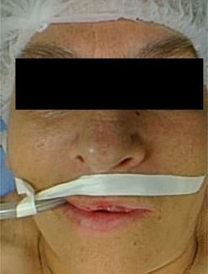 Imagen facial prequirúrgica (antes de la maxilectomía).