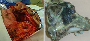 Transquirúrgico y pieza quirúrgica. A) Lecho quirúrgico posterior a la resección. B) Pieza quirúrgica con tumoración hiperpigmentada en la pared nasal externa.