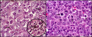Histopatología. A) Proliferación neoplásica, irregularidad de la membrana nuclear con cromatina desplazada a la periferia, nucléolo eosinófilo prominente. Se observa en el citoplasma pigmento melánico (flechas). B) Mitosis atípicas abundantes entremezcladas con células neoplásicas pleomórficas (flechas).