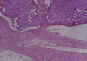 Imagen 4X de lesión infiltrativa en tejidos blandos, musculares, esqueléticos y adiposos.