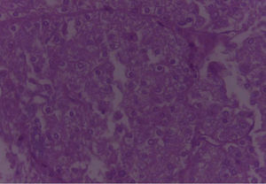 Imagen 40X de lesión tumoral de morfología acinar. Se aprecia citoplasma amplio, granular, con núcleos irregulares de cromatina abierta, que tienden a disponerse formando acinos. Figuras mitóticas no aparentes.