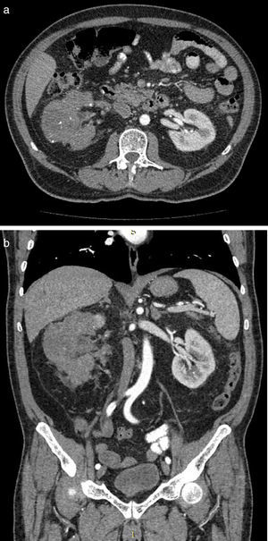 a y b. Tomografía axial computada de abdomen de corte axial (a) y coronal (b), donde se observa reducción del tamaño tumoral, con áreas de necrosis, realce mínimo de forma difusa, calcificaciones, además de regresión del trombo a nivel de vena renal y vena cava.