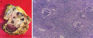 a y b. a) Vista macroscópica del riñón derecho; polo superior con mayor evidencia de necrosis tumoral. b) Examen microscópico donde se observa necrosis, sin evidencia de tumor residual.
