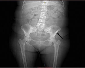 Radiografía de pelvis: Se aprecia osteoesclerosis en ambas ramas pubianas con predominio en lado izquierdo (flecha negra).