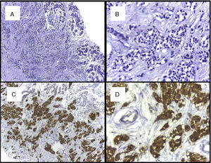 A) Tejido mamario con tinción H&E, que muestra una neoplasia maligna junto con tejido normal (H&E ×100). B) Tejido mamario con tinción H&E, que muestra células neoplásicas (H&E ×400). C) Estudio inmunohistoquímico de calcitonina, positivo en células mamarias compatibles con carcinoma medular de tiroides metastásico (H&E ×100). D) Células compatibles con carcinoma medular de tiroides captadoras de calcitonina (H&E ×400).