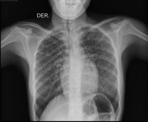 Radiografía de tórax que presenta metástasis en patrón militar del carcinoma medular de tiroides (CMT) en pulmón.