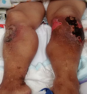 Fotografía clínica de la paciente mostrando tumoraciones en ambas piernas con lesiones costrosas y úlcera cicatrizada en la izquierda.