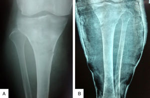A. Radiografía anteroposterior de la pierna derecha que muestra fractura patológica en el tercio proximal y densidad ósea heterogénea. B. Radiografía anteroposterior de pierna izquierda que muestra fractura patológica en el tercio proximal, densidad heterogénea, reforzamiento perióstico y aumento de volumen de partes blandas.