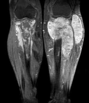(T1) Tumoración sólida homogénea hipercaptadora de 125×50×43mm, con compromiso óseo y de partes blandas en pierna derecha. Lesión similar en la pierna izquierda con menor compromiso óseo, pero mayor compromiso de partes blandas de 160×116×92mm.