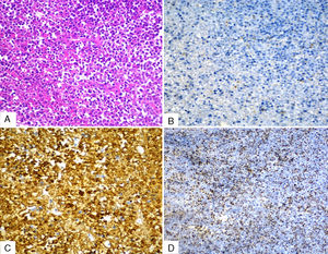 Microscopia ×40. A. Proliferación maligna de células neoplásicas difusas. (tinción: H-E). B. CD3: negativo. C. CD20: positivo. D. Ki67: positivo.