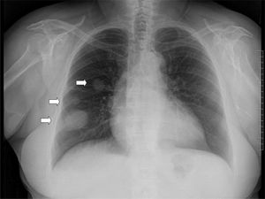 Radiografía de tórax, que muestra imágenes redondeadas radiopacas en el campo pulmonar derecho (flechas blancas).