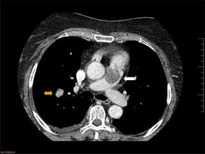 TC torácica (corte axial), que muestra voluminoso defecto intraluminal en el tronco común de la arteria pulmonar (flecha blanca), sugestivo de TEP, y también puede apreciarse M1 en parénquima pulmonar (flecha naranja).